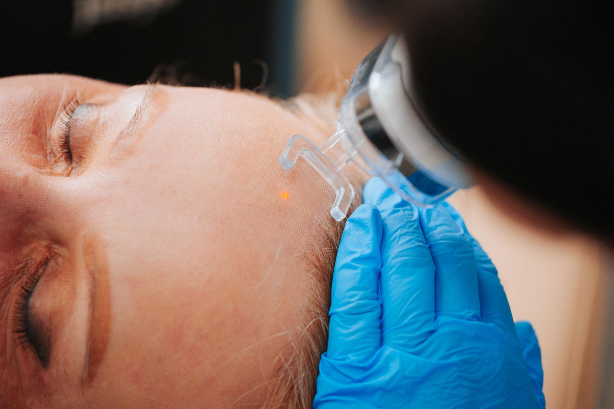 Vorher/Nachher – Fibrome entfernen