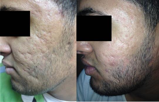 Vorher/Nachher – Skin Resurfacing Augenpartie
