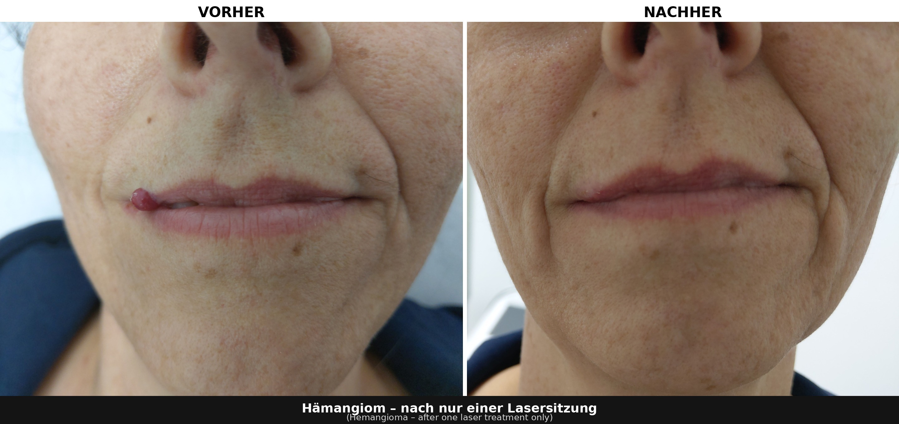 Vorher/Nachher – Fibrome entfernen